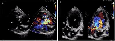 The Surgical Strategy for Progressive Dilatation of Aortic Root and Aortic Regurgitation After Repaired Tetralogy of Fallot: A Case Report